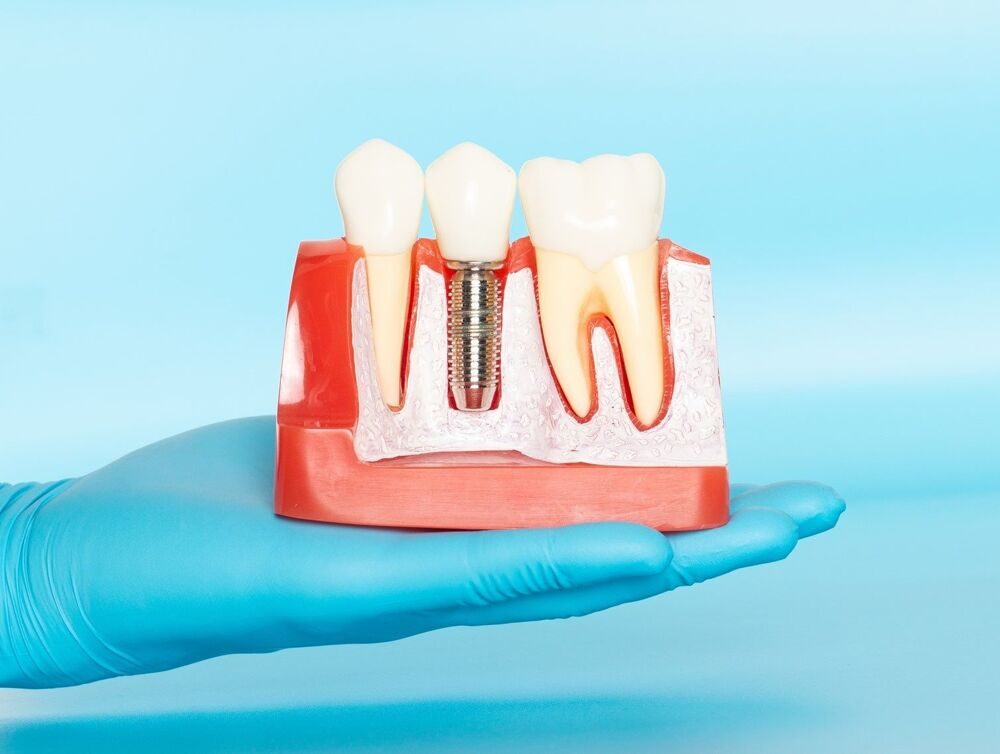 Этапы имплантации зуба