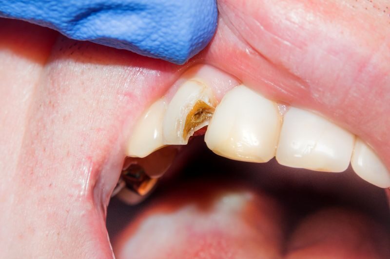 пломбирование зуба минск