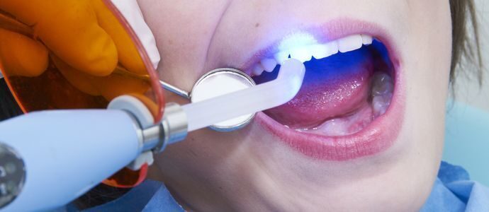 Лазерное лечение зубов